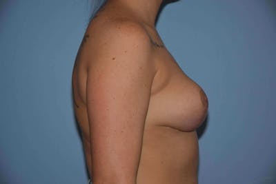 Breast Reduction Before & After Gallery - Patient 108426 - Image 6