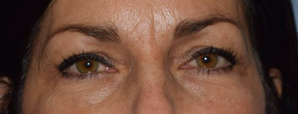 Eyelid Lift Before & After Gallery - Patient 205667 - Image 1
