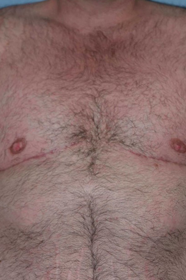 Gynecomastia Before & After Gallery - Patient 187816 - Image 2