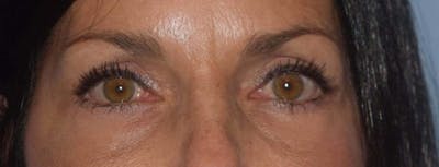 Eyelid Lift Before & After Gallery - Patient 205667 - Image 2