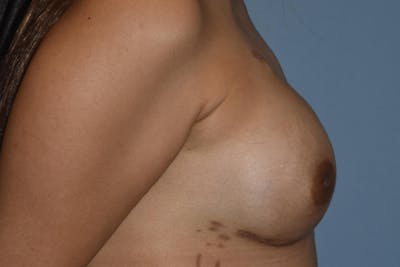 Breast Reconstruction Before & After Gallery - Patient 270531 - Image 6