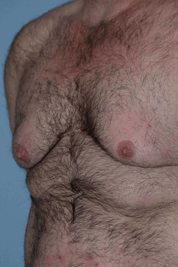 Gynecomastia Before & After Gallery - Patient 187816 - Image 5