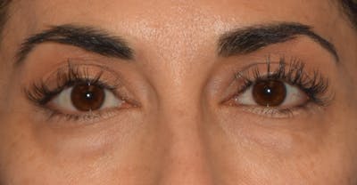 Eyelid Lift Before & After Gallery - Patient 568592 - Image 1