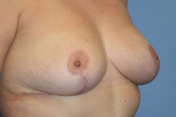 Breast Reduction Before & After Gallery - Patient 184872 - Image 4