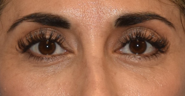 Eyelid Lift Before & After Gallery - Patient 568592 - Image 2