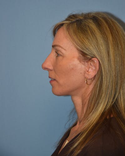 Facelift Before & After Gallery - Patient 380275 - Image 6