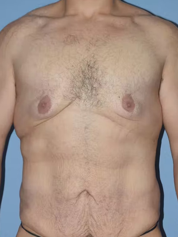 Gynecomastia Before & After Gallery - Patient 111389 - Image 1