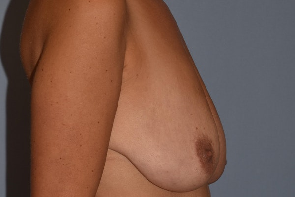 Breast Augmentation Lift Before & After Gallery - Patient 310242 - Image 5