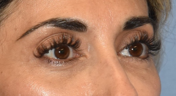 Eyelid Lift Before & After Gallery - Patient 568592 - Image 4