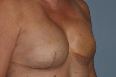 Breast Reconstruction Before & After Gallery - Patient 273167 - Image 4