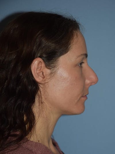 Rhinoplasty Before & After Gallery - Patient 160455 - Image 1