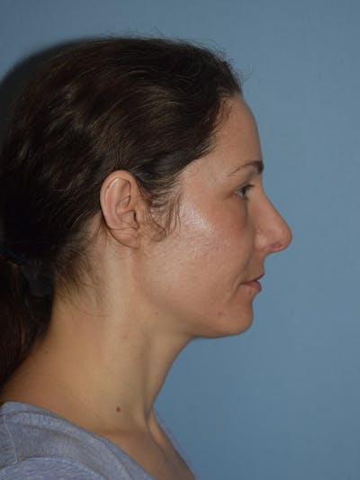 Rhinoplasty Before & After Gallery - Patient 160455 - Image 2