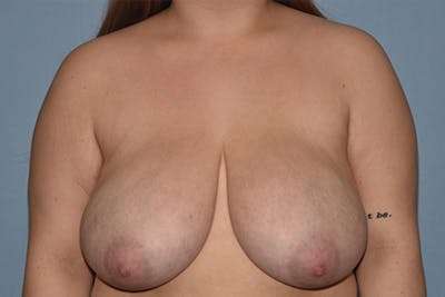 Breast Reduction Before & After Gallery - Patient 110086 - Image 1