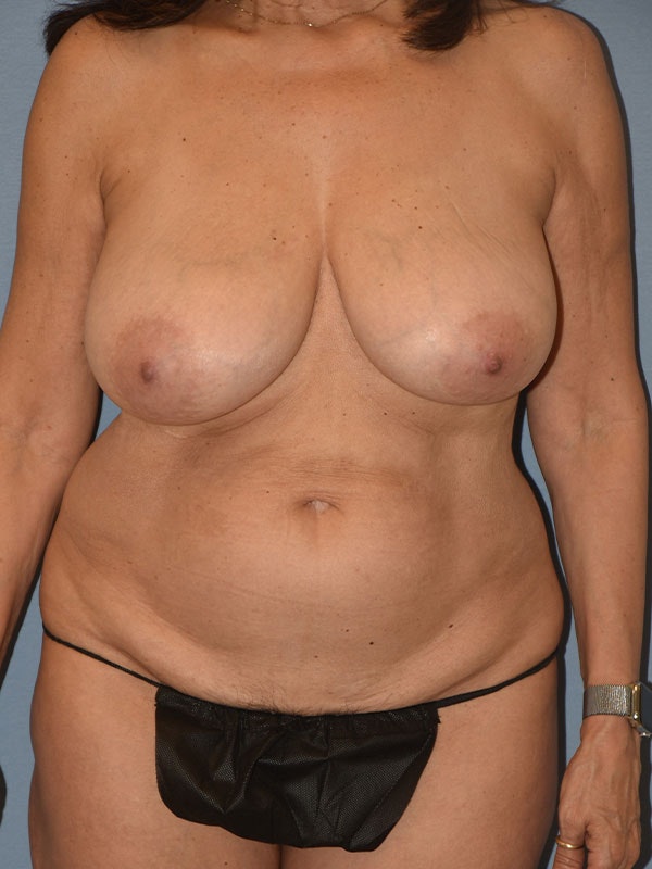 Mommy Makeover Before & After Gallery - Patient 350539 - Image 1