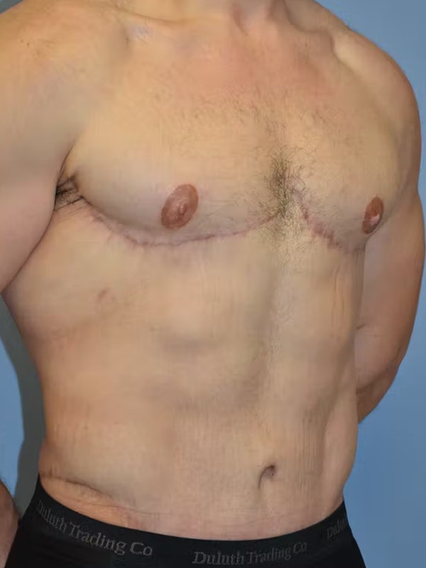 Gynecomastia Before & After Gallery - Patient 111389 - Image 4