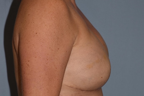 Breast Reconstruction Before & After Gallery - Patient 273167 - Image 6