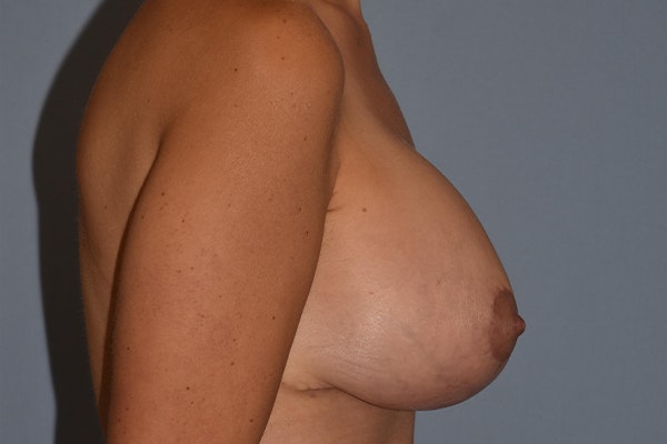 Breast Augmentation Lift Before & After Gallery - Patient 310242 - Image 6