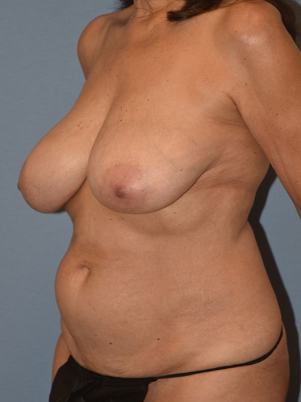 Mommy Makeover Before & After Gallery - Patient 350539 - Image 3