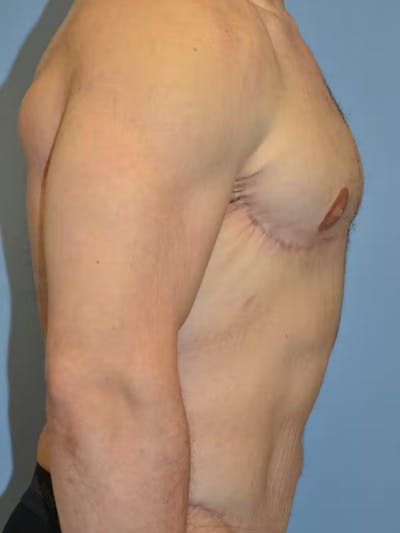 Gynecomastia Before & After Gallery - Patient 111389 - Image 6