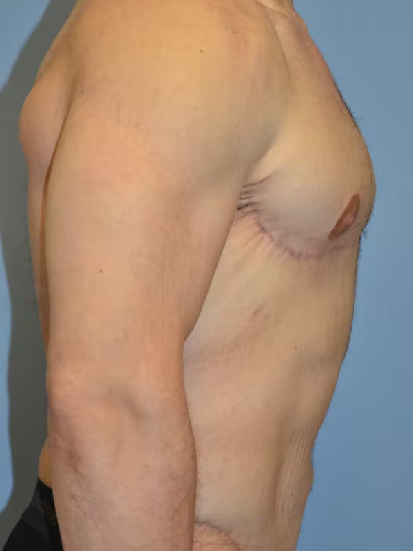 Gynecomastia Before & After Gallery - Patient 111389 - Image 6