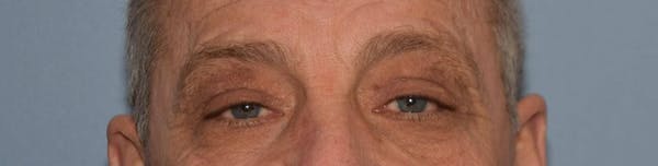 Eyelid Lift Before & After Gallery - Patient 132068 - Image 2