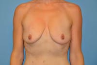 Breast Augmentation Lift Before & After Gallery - Patient 534292 - Image 1