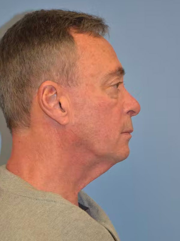 Facelift Before & After Gallery - Patient 843750 - Image 5