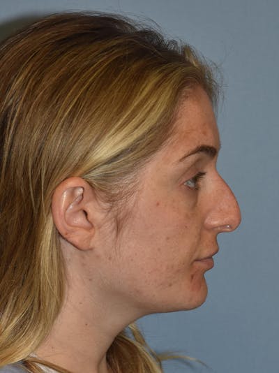 Rhinoplasty Before & After Gallery - Patient 366178 - Image 1