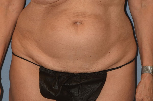 Tummy Tuck Before & After Gallery - Patient 273290 - Image 1