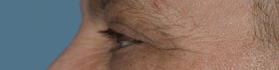 Eyelid Lift Before & After Gallery - Patient 132068 - Image 4