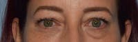 Eyelid Lift Before & After Gallery - Patient 169257 - Image 1