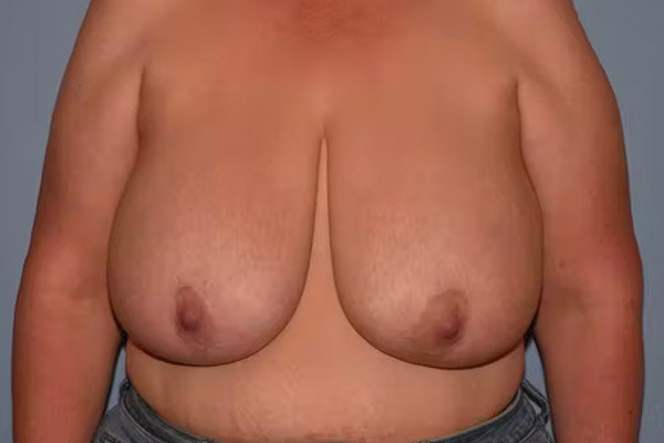 Breast Reduction Before & After Gallery - Patient 236567 - Image 1