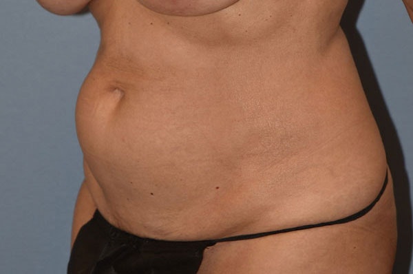 Tummy Tuck Before & After Gallery - Patient 273290 - Image 3