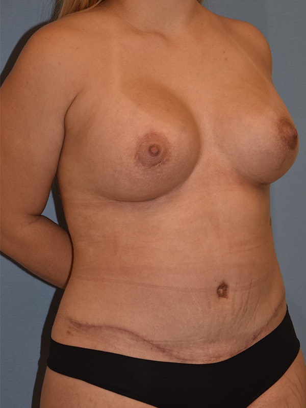 Mommy Makeover Before & After Gallery - Patient 159341 - Image 2