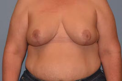 Breast Reduction Before & After Gallery - Patient 236567 - Image 2