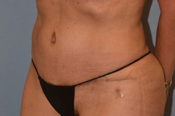 Tummy Tuck Before & After Gallery - Patient 273290 - Image 4
