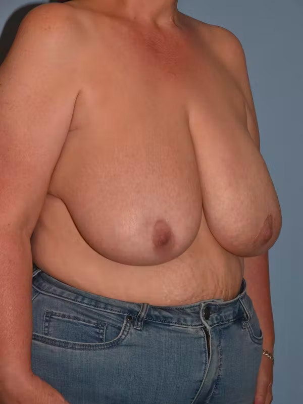 Breast Reduction Before & After Gallery - Patient 236567 - Image 3