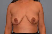 Breast Augmentation Lift Before & After Gallery - Patient 337965 - Image 1