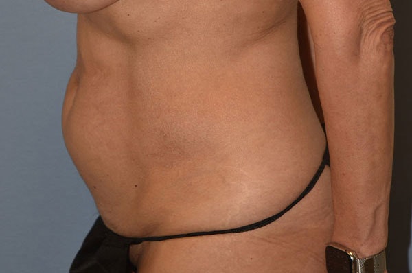 Tummy Tuck Before & After Gallery - Patient 273290 - Image 5