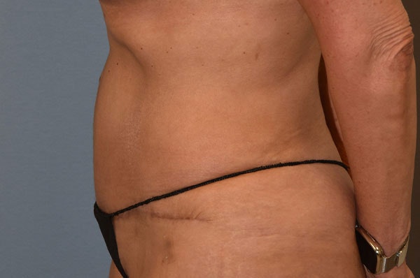 Tummy Tuck Before & After Gallery - Patient 273290 - Image 6