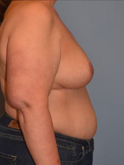 Breast Reduction Before & After Gallery - Patient 236567 - Image 6