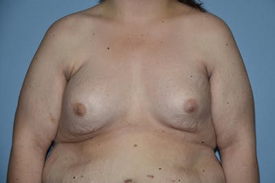 Breast Reconstruction Before & After Gallery - Patient 277820 - Image 1