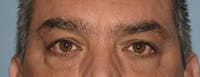 Eyelid Lift Before & After Gallery - Patient 406858 - Image 1