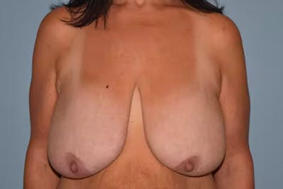 Breast Reduction Before & After Gallery - Patient 124900 - Image 1