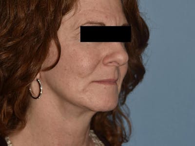Facial Fat Grafting Before & After Gallery - Patient 125534 - Image 4