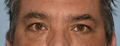 Eyelid Lift Before & After Gallery - Patient 406858 - Image 2