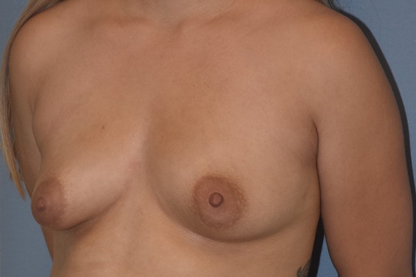 Breast Augmentation Before & After Gallery - Patient 794424 - Image 3