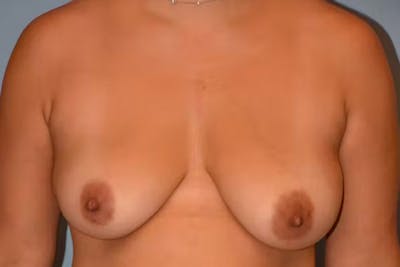 Breast Augmentation Lift Before & After Gallery - Patient 172869 - Image 1