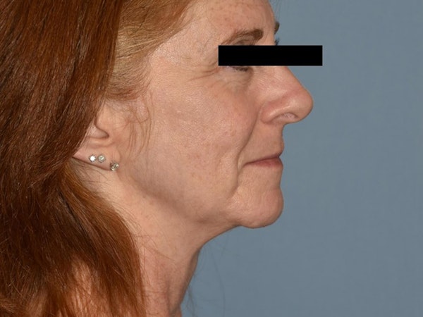 Facial Fat Grafting Before & After Gallery - Patient 125534 - Image 5