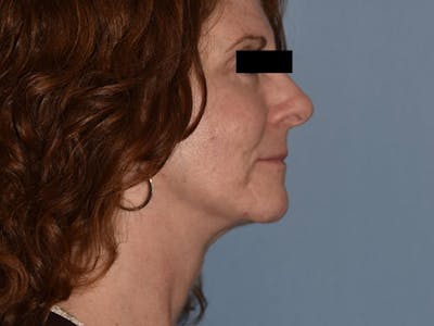 Facial Fat Grafting Before & After Gallery - Patient 125534 - Image 6